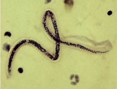 Bancroftova filarija